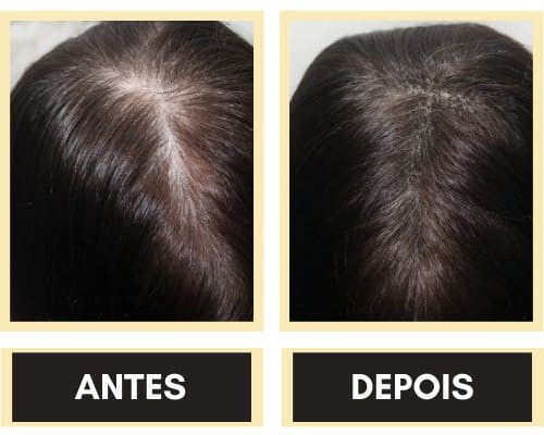 Trinoxidil Tonico De Crecimento Capilar 100 Ml 