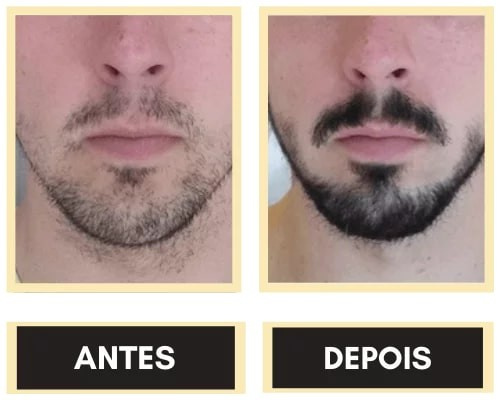 Trinoxidil Tonico De Crecimento Capilar 100 Ml 
